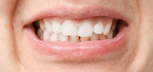 Comment Prisma Dentistes traite-t-il les désalignements dentaires ?